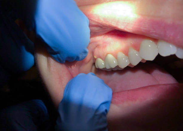 Best Emergency Wisdom Teeth Removal in Barbourmeade, KY